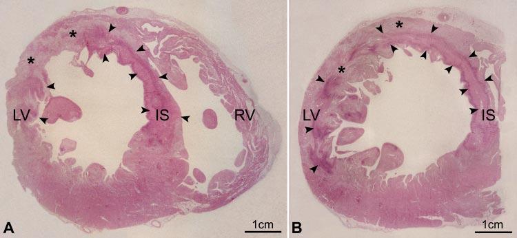 ADULT STEM CELLS 1397 FIG. 11. Myocardial infarcts incompatible with survival.