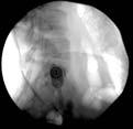 ablations SIJ injections Open arthrodesis reserved for refractory cases due to surgical complications, prolonged hospital stays and