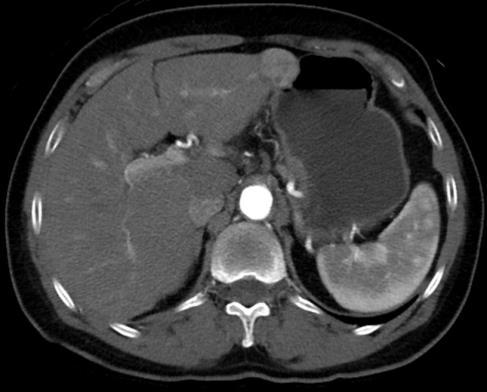 HCC Diagnosis: Radiological Features 4-Phase CT Non-contrast