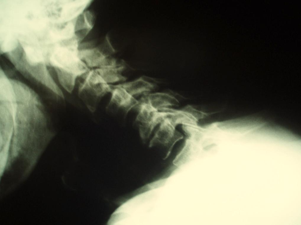 Lateral cervical spine X-Ray showing anterior cervical discectomy and fusion at C3-C4, C4-C5 using PEEK allograft, and anterior fixation with dynamic plate and screws from C3 to C5.