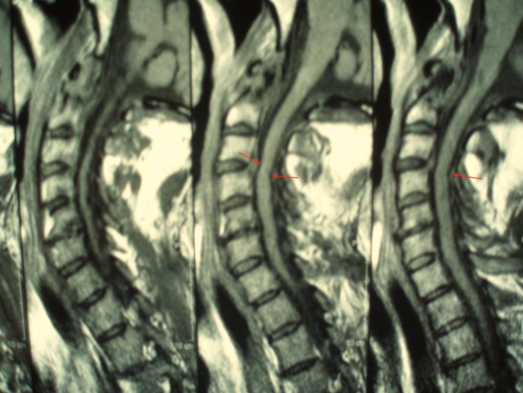 Although repeat cervical spine MRI scan did not reveal any abnormal findings, lateral cervical spine flexion-extension radiographs revealed hardware failure with cervical spine instability
