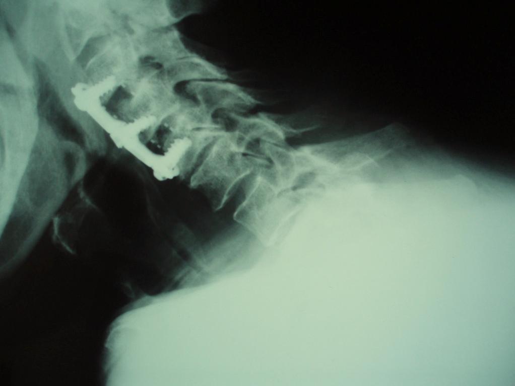 Lateral cervical spine flexion X-Ray showing spondyloarthropathy with vertebral body degeneration, C3-C4 and C4-C5 instability and spurs. Fig. (3).