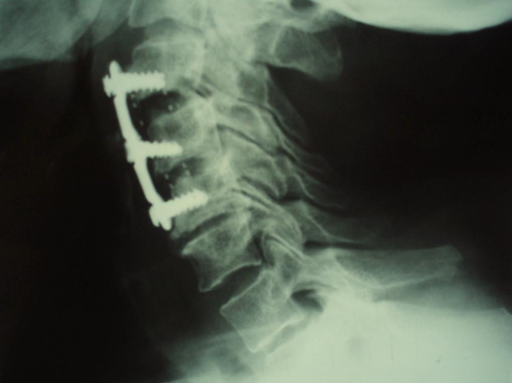 Cervical Spondyloarthropathy in Hemodialysis The Open Orthopaedics Journal, 2010, Volume 4 41 The patient then underwent repeat cervical spine surgery, which consisted of anterior fusion revision