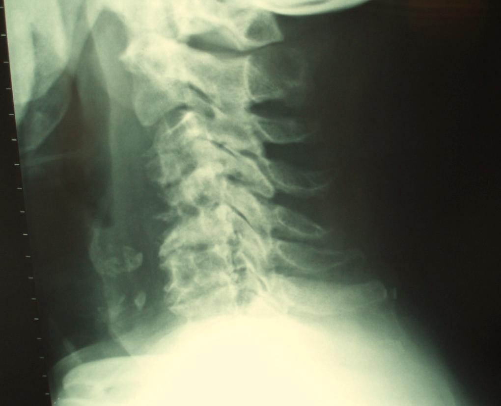 5) reveals hardware failure with cervical spine instability. Fig. (8). Cervical spine lateral X-Ray showing partial destruction of the C3 and extensive destruction of the C4 and C5 vertebral bodies.