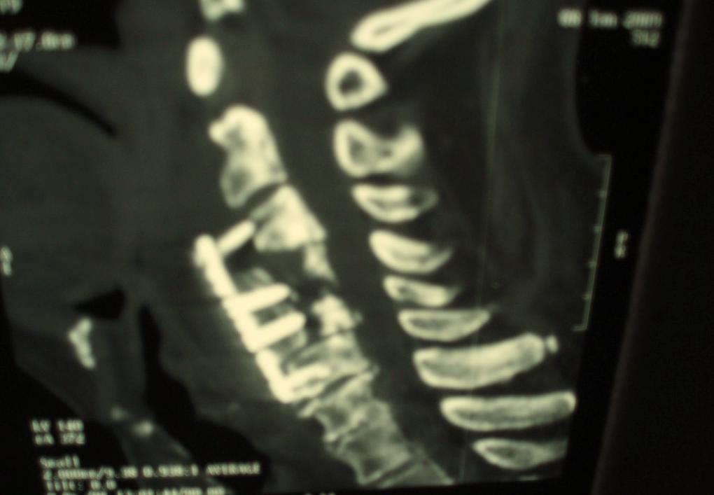 Postoperative cervical spine CT showing hardware failure at C3 with anterior shift of the allograft. Fig. (12).