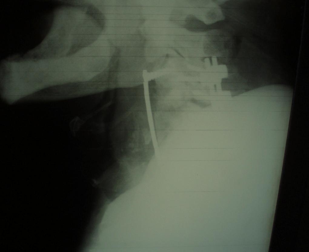 anterior approach due to anterior compression, with one of the two requiring supplemental posterior fixation because of hardware failure and pseudarthrosis [9].