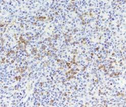 This diffuse large B-cell lymphoma was EBV-encoded small RNA positive; clonality testing, however, was unsuccessful (H&E, 250).