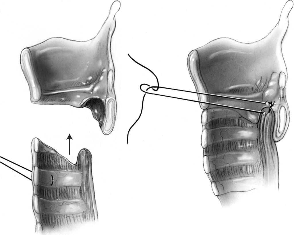 Surgical management of subglottic stenosis 63 Figure 10 The anastomosis is much the same as the standard case except for the posterior mucosal flap. The same lateral stay sutures are placed.
