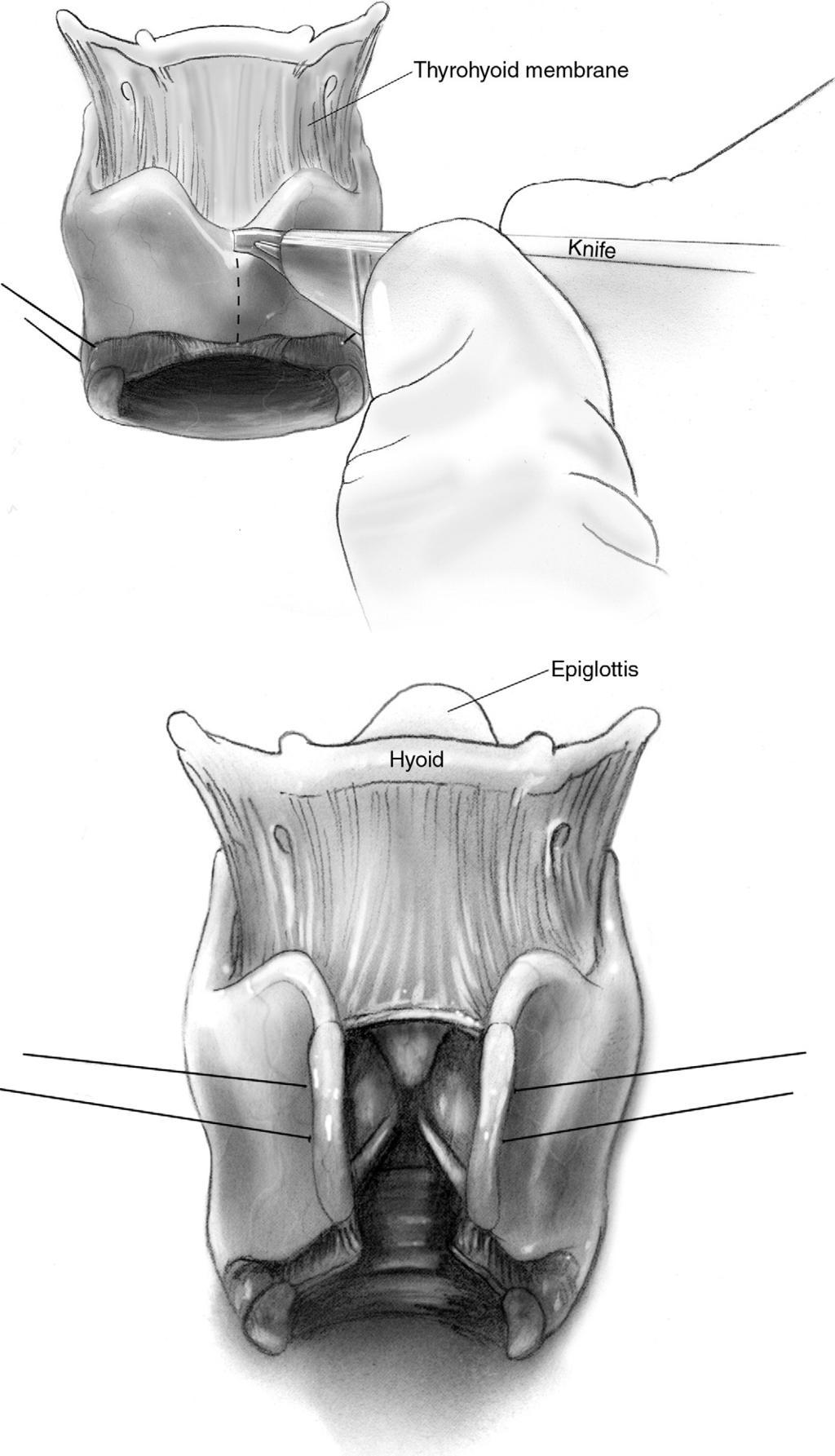 64 C.D. Wright Figure 11 If needed, a laryngofissure is performed by vertically splitting the thyroid cartilage exactly in the midline.