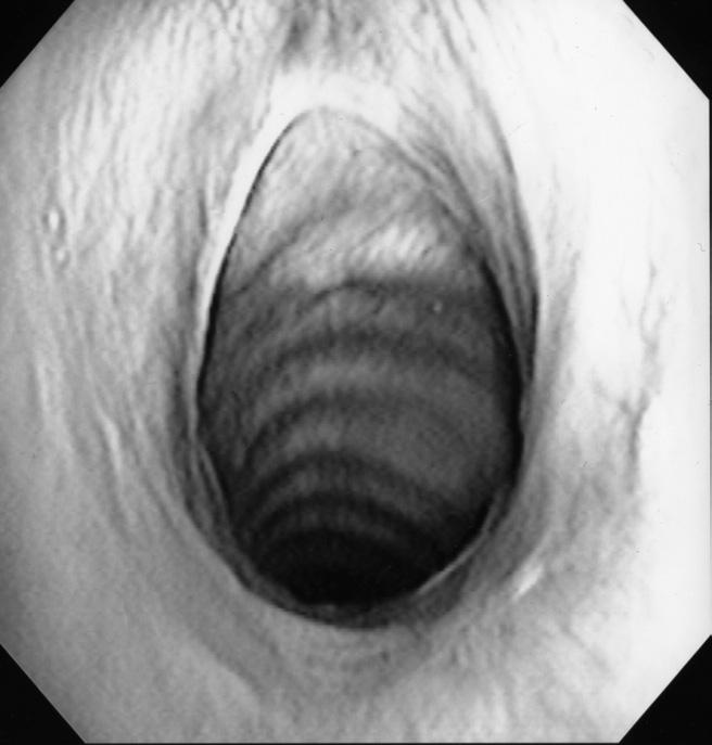Surgical management of subglottic stenosis 65 Results In a recent series review of idiopathic laryngotracheal stenosis, we reported 91% of patients had good to excellent results with only 1% needing