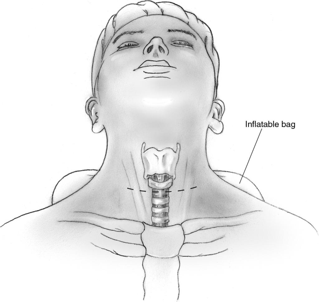 Surgical management of subglottic stenosis 55 Operative Technique Figure 3 The patient is supine on the operating room table with an inflatable bag underneath the shoulders to extend the neck.