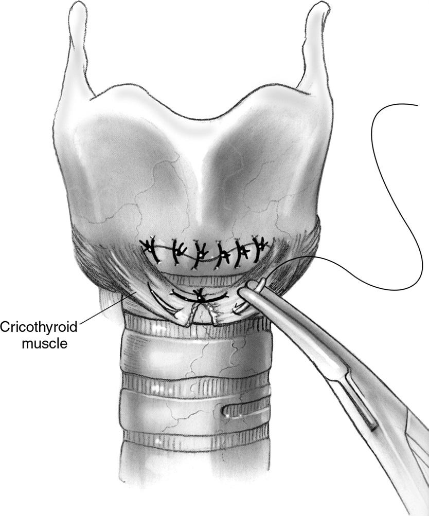 Surgical management of subglottic stenosis 61 Figure 8 The cricothyroid muscles are reattached over the anastomosis with two fine sutures which typically include a bite of muscle, the