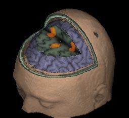 CHAPTER 6. FUNCTIONAL NEUROANATOMY Fig. 6-2b: 3D-rendered view of the three premotor/precentral gyrus activity clusters.