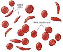 Sometimes these red blood cells become sickle-shaped (crescent shaped) and have difficulty