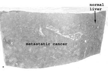 Slide 47: Liver with metastatic cancer As with slides of this sort, look at the uninvolved liver first and then move to the region of pathology.