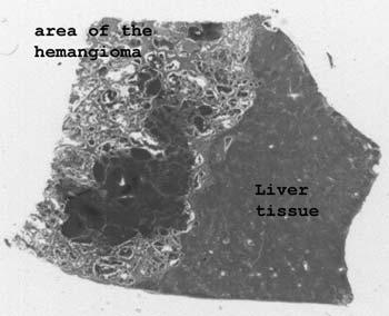 Slide 71: Liver with hemangioma This should be obvious to the most casual of observers.