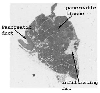 Slide 75: Fatty infiltration of pancreas The changes of importance here are probably better seen in this scan of the tissue than by use of the microscope.