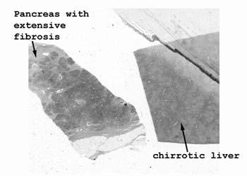 Slide 92: Liver with cirrhosis Even though this slide is generally faded, it is still possible to see the nodularity of the liver by just viewing it on a white