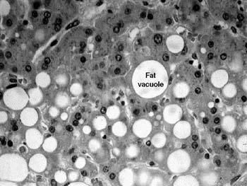 The former is the most widely used. It is a rather nonspecific alteration, but one we see commonly in biopsies of the liver. The fat vacuoles are within the hepatocytes.