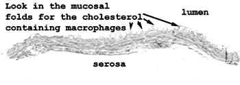 Slide 137: Gallbladder with cholesterolosis Look in the little mucosal folds for the lipid laden histiocytes.
