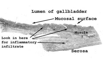 Slide 27: Gallbladder with acute and chronic inflammation This section represents only a small slice out of a dilated, inflamed (and no doubt painful) gallbladder.