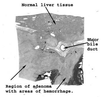 Slide 29: Liver with hepatic adenoma It's a little tricky to see the area of the adenoma if all you do is slap the slide on the stage of your scope.