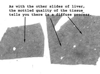 Slide 42: Liver with cirrhosis Here just looking at the tissue on the slide, you can see the evolving nodular pattern so characteristic of cirrhosis.