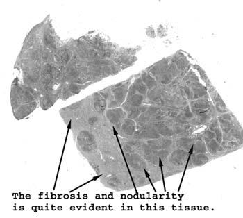 Slide 45: Liver with post necrotic cirrhosis I'll bet you can't miss the nodularity and scarring in this example of cirrhosis.