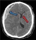 Therapeutic areas Stroke Ischemic Stroke Haemorragic Stroke Traumatic Brain Injury Due to accident Due to surgery Dementia Alzheimer s disease