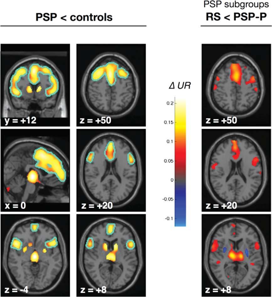 FIG. 1. Putaminal, thalamic, and frontal uptake ratios in RS, PSP-P, PD, and controls.
