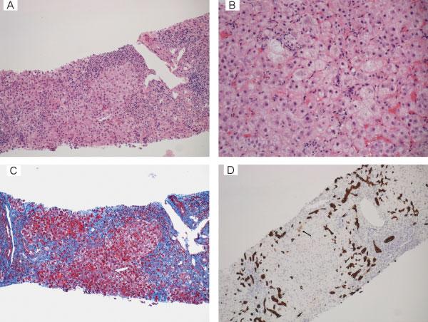 Succesful Treatment of Fibrosing Cholestatic Hepatitis C Kim et al. 111 Fig. 3 Liver biopsy 15 months after liver transplantation.