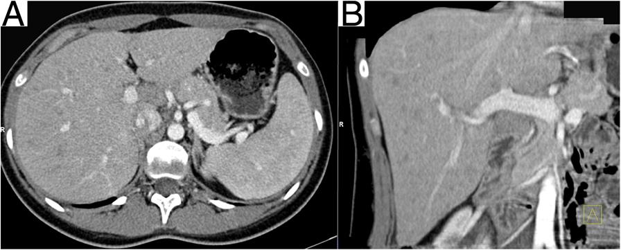 Lagler et al. BMC Infectious Diseases 2014, 14:357 Page 3 of 5 Figure 2 Radiographic findings of abdominal computed tomography during Katayama syndrome (axial (A) and coronal (B) reconstruction).