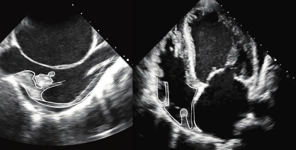 Mobile vegetation attached to the catheter (thickened tip) on transthoracic echo (left) and the adjacent wall (right) seen in TEE.