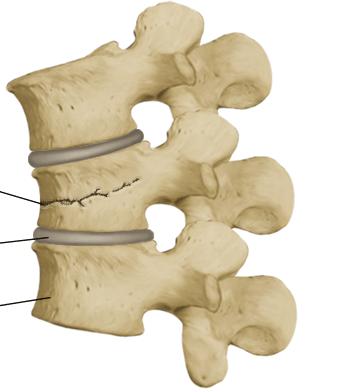 Vertebral fractures 35 to 50% of all women over fifty have at