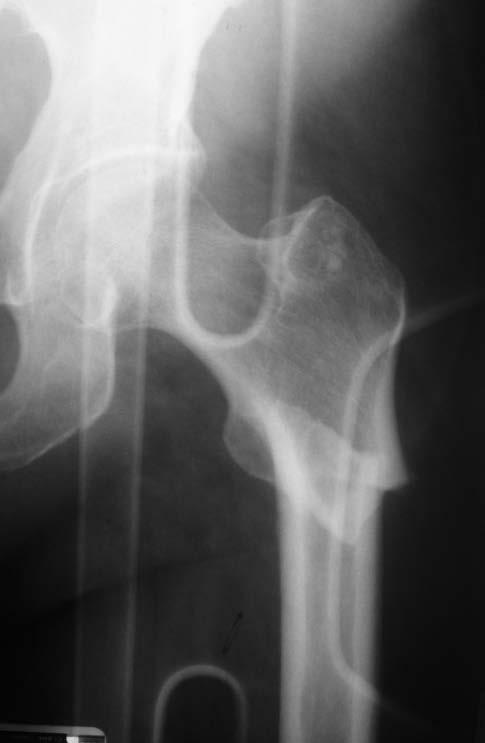 Proximal Femoral Fractures Incidence increases each decade for all