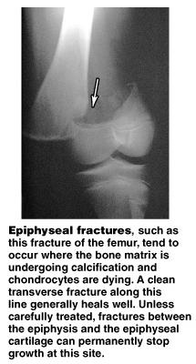Repair: Step 4 Osteoblasts and osteocytes remodel the fracture for up to a year: