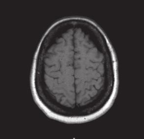 A report of nontraumatic cortical subarachnoid hemorrhage & subsequent management Case Report further headache or focal neurologic deficits.