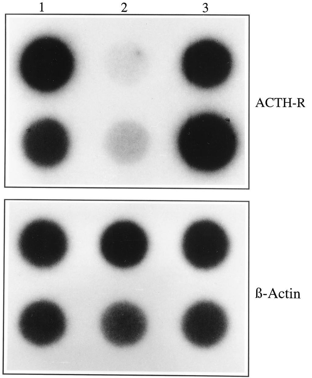 Left, Adrenal adenoma without LOH. FIG. 4. ACTH-R mrna expression in adrenocortical tumors assessed by dot blot.