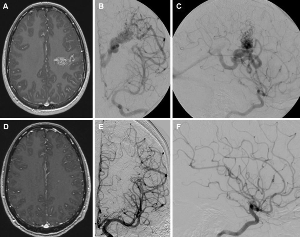 288 Acta Neurochir (2015) 157:281 291 Fig. 4 Case example of a pediatric patient with an unruptured AVM who was treated with radiosurgery. A 13-year-old boy had an incidentally diagnosed AVM.