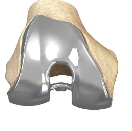 profile 1 Mahoney, et al; Overhang of the Femoral Component in Total