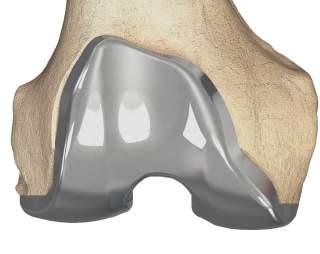 Respecting each patient s condylar shape: Retains each patient s medial and lateral joint line and condylar offset Provides stability through range of