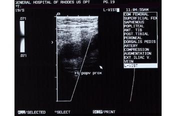 Long Axis Image:DVT POPV PROX after L-Vist injection Figure 4 DVT LT POPV PROX :With color duplex sonography blood flow is seen -to tricklearound the thrombus DVT LT POPV PROX:There is