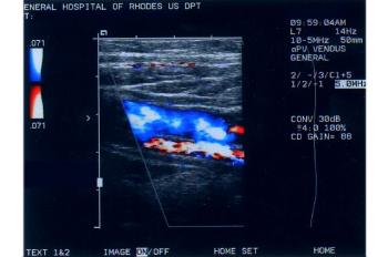 axis Image:Lack of Compressibility Deep Venous Thrombosis Popliteal