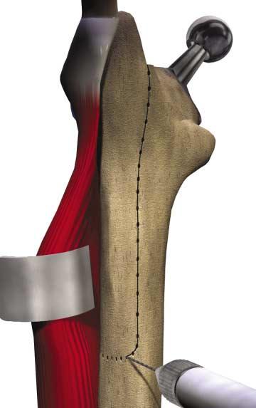 When this point is reached, carry the osteotomy anterolaterally for a distance of onethird the femoral circumference.