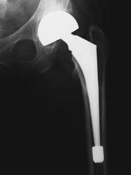 Revision of the femoral component: extensive coatings. The Adult Hip.