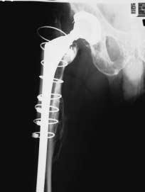 An Extended Trochanteric Osteotomy for Revision Total Hip Replacement.