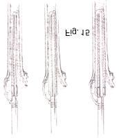 Step 5 - Integral 180 Reaming the Femur For the Integral 180 Component The femoral canal is identified with a hand-held starter reamer (Fig. 13).