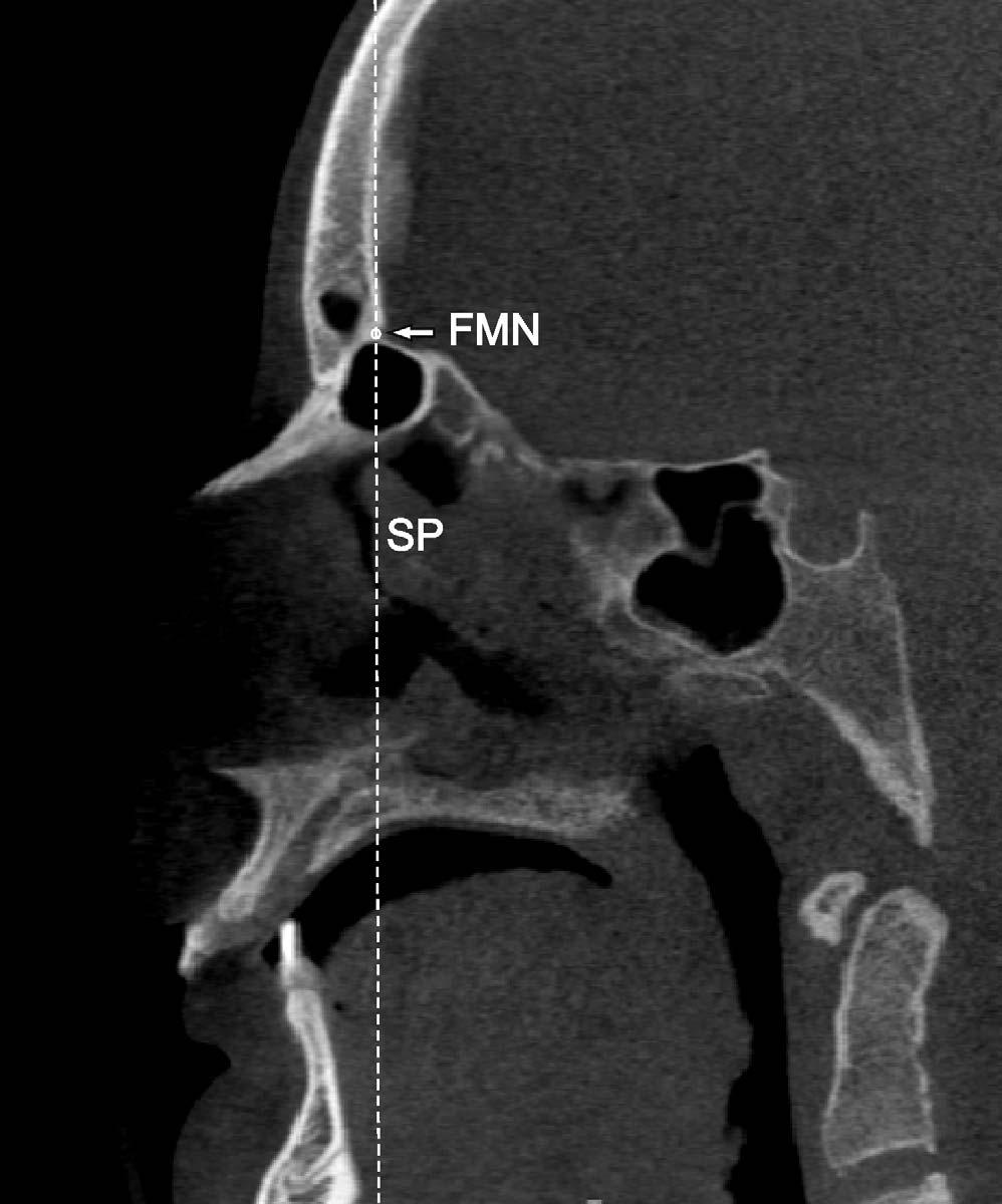 FOSSA AND CONDYLE POSITION IN CLASS II SUBDIVISION 849 Figure 1. Identifiction of the stble plne (SP). A verticl dshed line tngent to the front mxillo nsl point is drwn.