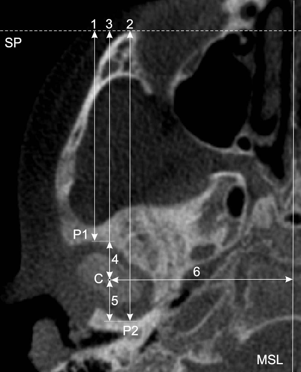 P1 ws locted in the most nterior internl contour of the glenoid foss nterior wll; P2 ws locted in the most posterior internl contour of the glenoid foss posterior wll; nd C ws the geometric center of