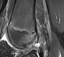 preadolescents with a traumatic ti knee effusion